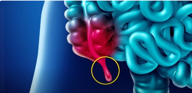 Appendix Cancer: A Rare Disease Rising in Younger Adults 1 AC 2 Dashing News